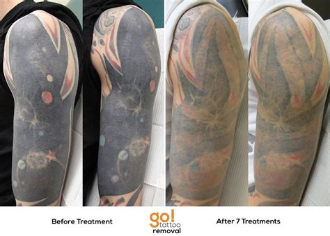 5 Most Frequently Asked Questions About Pain Free Tattoo Removal Artofit