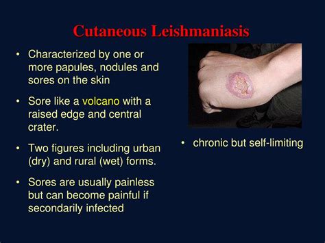 Ppt Leishmaniasis Powerpoint Presentation Free Download Id4596988