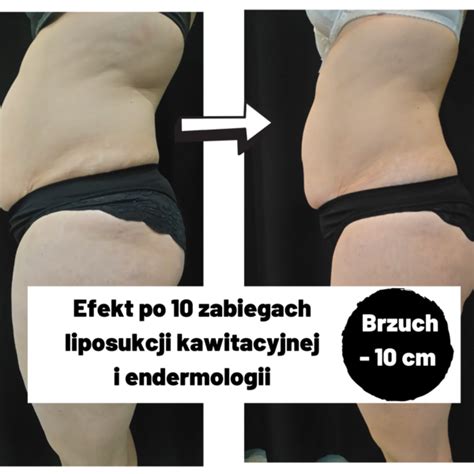 Endermologia Toru Usuwanie Cellulitu Modelowanie Sylwetki