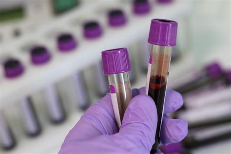 Single Blood Test Predicts Year Cardiovascular Disease Risks For Women