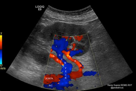 Renal Artery Doppler Ultrasound Worksheet