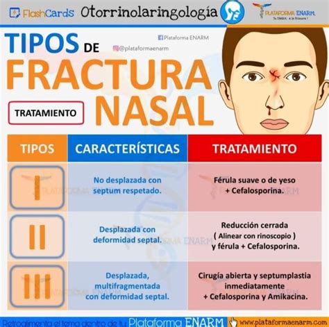 Tipos De Fractura Nasal Cosas De Enfermeria Medicina De Urgencias