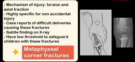 METAPHYSEAL CORNER FRACTURES