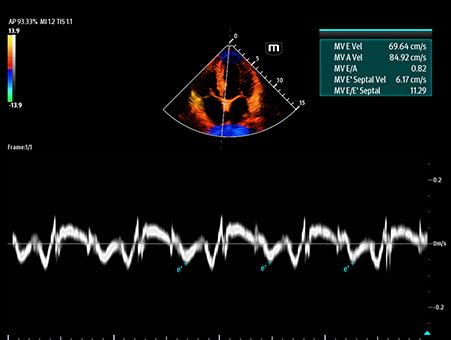 Critical Care Ultrasound Solution Mindray