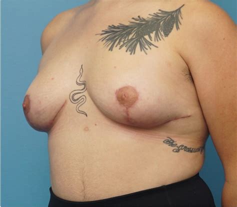 Breast Lift In Chicago And The North Shore Dr Akhil Seth