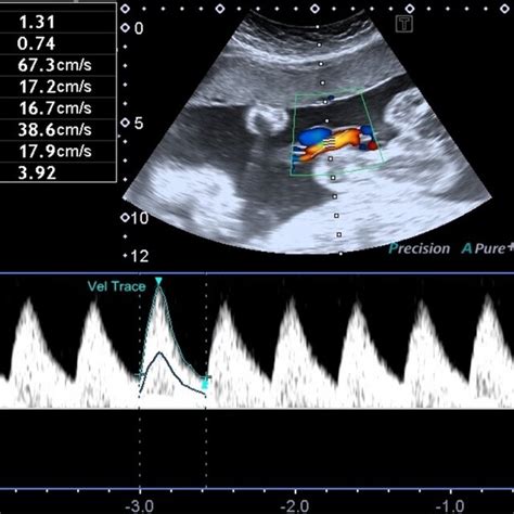 Flow Pattern And Doppler Ultrasound Indexes Of The Umbilical Artery In Download Scientific