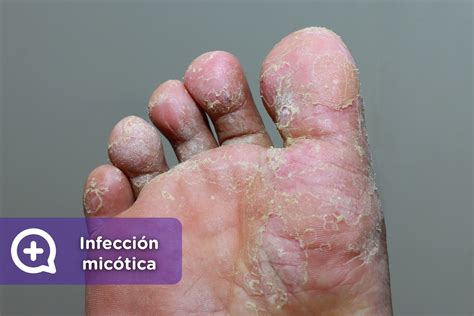 Micosis causas síntomas y tratamiento mediQuo