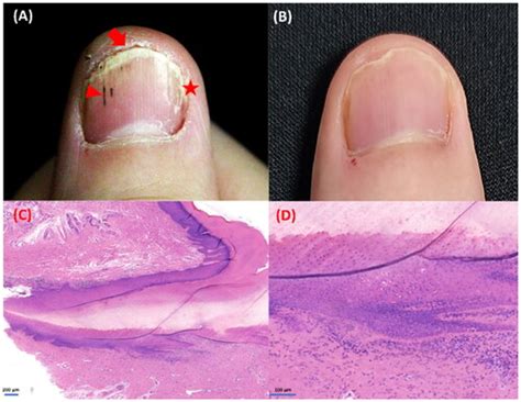 Full Article Alleviation Of Isolated Nail Lichen Planus By The Jak12