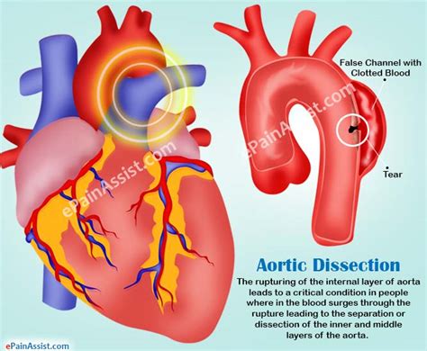 Aortic Dissection|Types|Causes|Symptoms|Treatment|Survival Rate ...