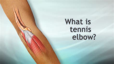 Tennis Elbow Surgery