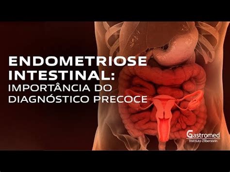 Endometriose Intestinal Import Ncia Do Diagn Stico Precoce Gastromed