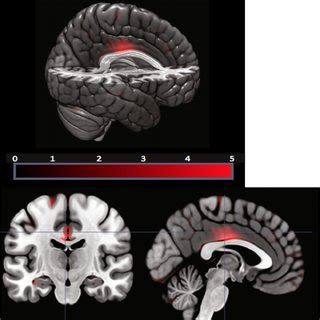 Social Potency SP Whole Brain Voxel Based Morphometry VBM Results