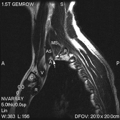 Ntos Patient Scalene Triangle Sagittal Plane The Anterior Scalene