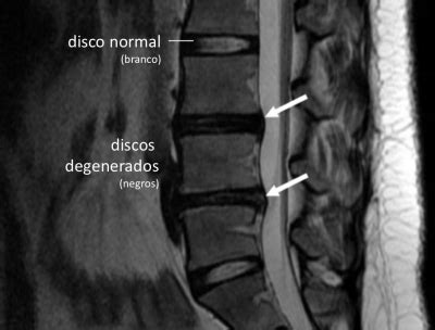 Espondilose S O Desgastes Da Coluna Dr Alberto Gotfryd