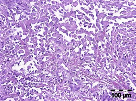 Oral Acantholytic Squamous Cell Carcinoma Shares Clinical And