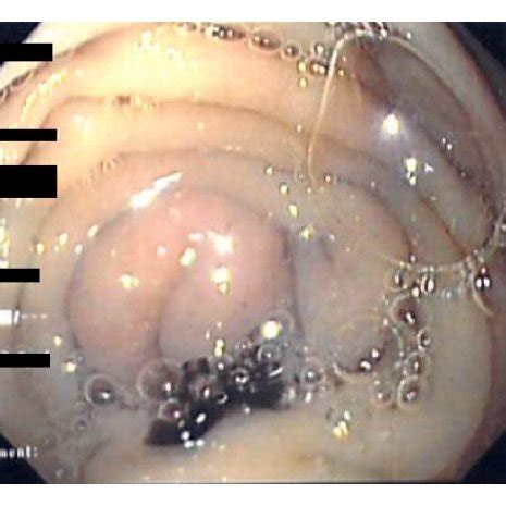 Percutaneous Transhepatic Cholangiography Showed Diffuse Dilation Of