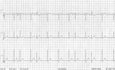 Pedi cardiology: Atrial Ectopy