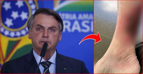 Urgente Veja Como Est A Perna De Bolsonaro Que Est Gravemente