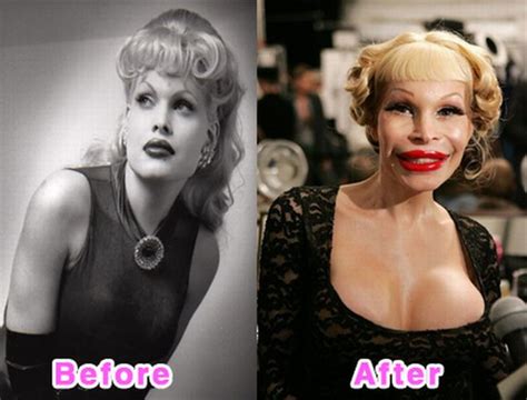 Celebrity Plastic Surgery Disasters Before And After 16 Pics