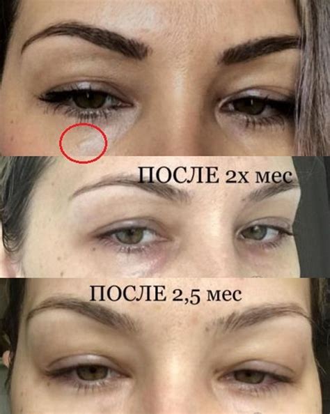 Мезонити Под Глаза Фото — Bluemorphotours.ru