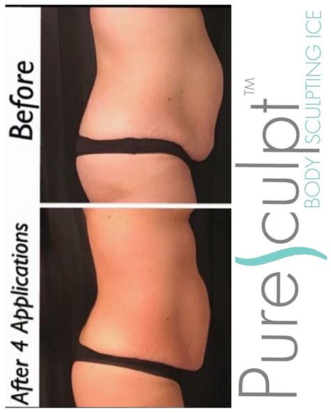 Transform Your Body With Puresculpt Ice Therapy