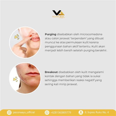 Perbedaan Purging Dan Breakout Pesona Ayu Beauty Clinic