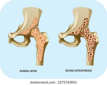 Bone Density Osteoporosis Vector Illustration Stock Vector (Royalty ...