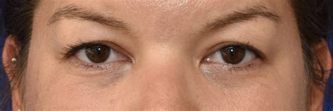 Eye Gallery Upper Eyelid Surgery Plastische Chirurgie Zentrum F R