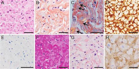 Figure Pathologic Findings Of The Cardiac Biopsy Specimen A E Case