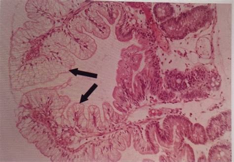 Pathology Gi Flashcards Quizlet