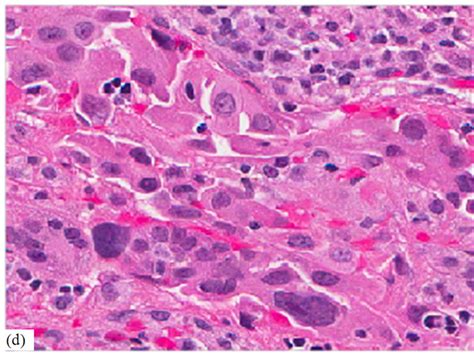 anaplastic carcinoma thyroid histology