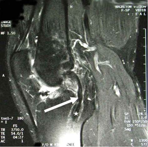 PCL Reconstruction | Posterior Cruciate Ligament Surgery | Minnesota