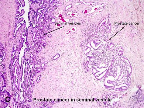 American Urological Association Introduction To Prostate Carcinomas