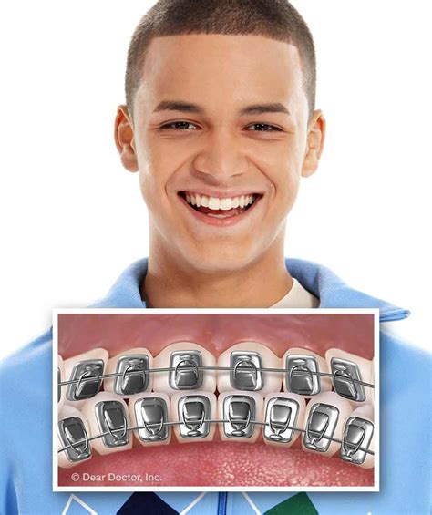 Types Of Braces Coghlan Orthodontics Bloomington Indiana