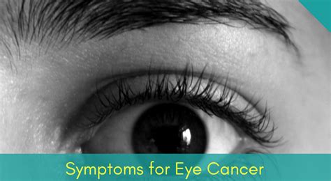 4 Categories And Symptoms Of [eye Cancer] You Must Know