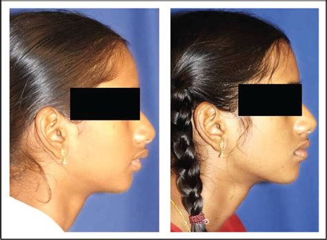 Management Of A Skeletal Class Ii Malocclusion Using 2 Phase Treatment An Indian Board Of