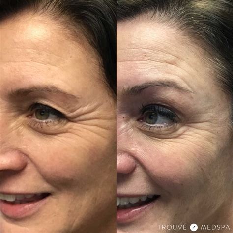 Awasome How Long Does It Take For Botox To Work On Crows Feet References