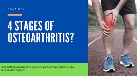 4 Stages Of Osteoarthritis Ppt