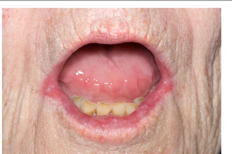 Niacin Deficiency Tongue