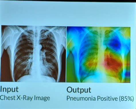 Application Of Computer Vision In Health Care By Anushka Srivastava