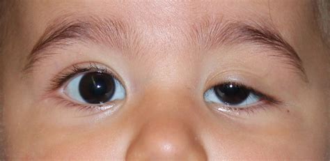 Congenital Ptosis