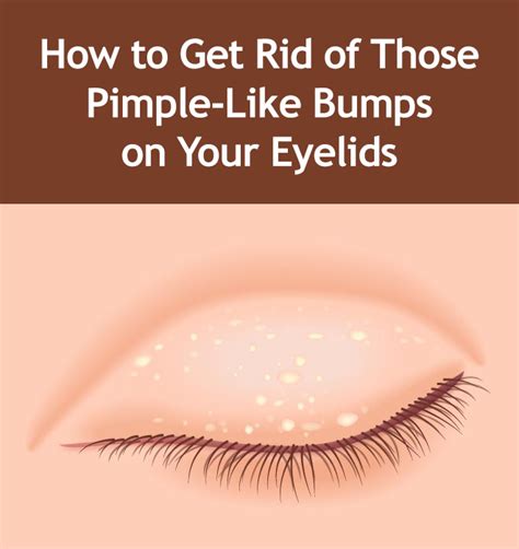 How To Get Rid Of Milia Tiny Bumps On Eyelids How To Remove Pimples How To Get Rid How To Get