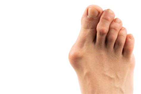 Hallux Valgus Ballenzeh Konservativ Behandeln Oder Operieren