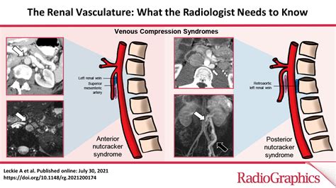 The Renal Vasculature What The Radiologist Needs To Know Radiographics