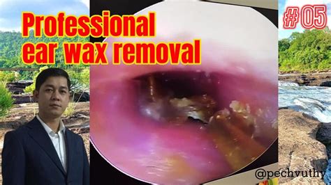 Professional Ear Wax Removal Youtube