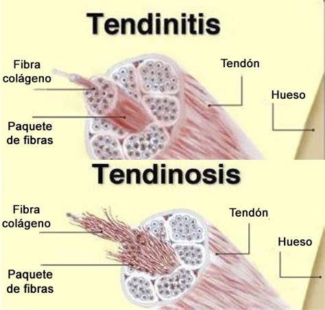 Tendinitis y Tendinosis Clínica Lenira Santolaya