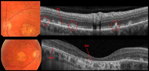 Dots Spots And Other White Retinal Lesions Page 39 Of 61 Retina Revealed