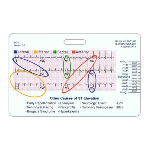 Lead Stemi Tool W Corresponding Vessels Chart Horizontal Badge Card