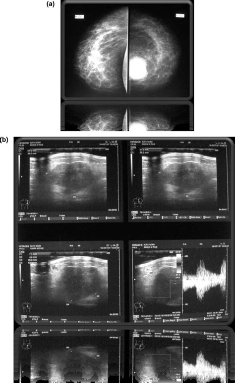 54 Yrs Old Female With History Of Left Lumpectomy 1 Year Ago Presented