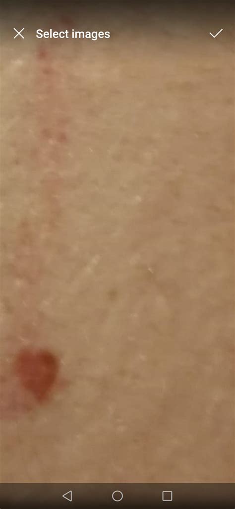 This mole has suddenly got really itchy. I've been noticing it for a while and often check it's ...